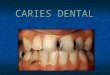 Caries dental consultorio odontologico