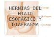 Hernias del hiato esofgico y diafragma