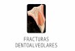Fracturas Dentoalveolares- Parte Karen