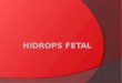 Hidrops Fetal