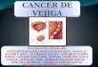Cancer de Vejiga Presentacion Diapositivas URO