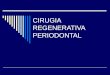 Cirugia Regenerativa Periodontal