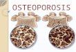 Osteoporosis Diapositiva