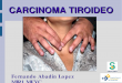Carcinoma tiroideo
