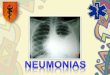 Proceso de Enfermeria en Neumonia
