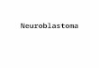 1 Neuroblastoma y Linfoma de Hodgkin.pptx