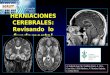 HERNIACIONES CEREBRALES: Revisando lo fundamental A. Gallardo Juan, M.J. Guillém Llácer, A. Glez-Cruz Soler, I. Elía Martínez, V. Martínez Sanjuán, J