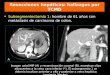 Subsegmentectomía 1: hombre de 61 años con metástasis de carcinoma de colon. Resecciones hepáticas: hallazgos por TCMD Imagen axial MIP (A) y reconstrucción