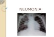 NEUMONIA. Definición La neumonía es la infección del parénquima pulmonar, con afectación de los espacios alveolares, que son ocupados por microorganismos