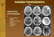 IMAGEN TOMOGRAFICA T.E.C. HEMATOMA INTRACEREBRA L tejido cerebral dañado opuesto o directo al impacto Tratamiento variable