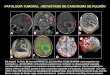 PATOLOGÍA TUMORAL : METASTASIS DE CARCINOMA DE PULMÓN ( A) Sagital T1 Flair, B) Coronal FRFSE T2, (C) Axial Flair T2 (D) 3D SPGR corte superior con contraste