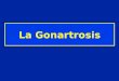 La Gonartrosis. Gonartrosis estática 1 sujeto sobre 100 entre 55 y 64 años 2 % de hombres 6,6 % de mujeres entre 65 y 75 años