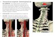 Transverso-espinal: Semiespinal de la cabeza: Se origina desde una serie de tendones que parten desde los extremos de los procesos transversos desde C7
