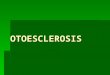 OTOESCLEROSIS. DEFINICION  OSTEODISTROFIA DE LA CAPSULA LABERINTICA.  TIPOS:FOCAL DIFUSA DIFUSA  HEREDITARIA DOMINANTE.  MUJERES 20-50 AÑOS  FACTORES