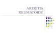 ARTRITIS REUMATOIDE. ARTRITIS REUMATOIDE (AR) Enfermedad inflamatoria crónica recurrente y sistémica, lesiona las articulaciones Se caracteriza por