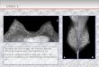 Paciente de alto riesgo con mamas densas, difícil de evaluar por mamografía (a; b). Áreas de realce bilateral tipo non mass “en racimo”, sugestivo de enfermedad