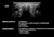 volumen tiroides:  0,5 x diámetro L x diámetro T x diámetro AP en cada lóbulo