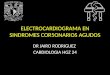 Electrocardiograma en Sindromes Cor5onarios Agudos
