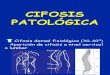 37.1 - patología del raquis II (cifosis)