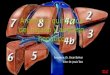 anatomia quirurgca de higado y absceso hepatico