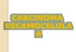 Carcinoma escamocelular y basocelular