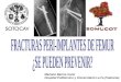 Mariano Barres. Fracturas peri-implantes de fémur. ¿Se pueden prevenir?