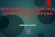 ENFERMEDAD PULMONAR INTERSTICIAL DIFUSA EPID