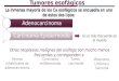 Patología - Adenocarcinoma Esofagico