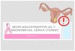 neoplasia intraepitelial cervical y carcinoma del cervix uterino