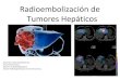 Radioembolización lesiones hepáticas