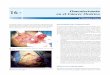 16 Omentectomía en el Cáncer Ovárico - media.axon.esmedia.axon.es/pdf/78866_2.pdf · Fig. 16.5: Omentectomía total que muestra al estómago (1), arteria gástrica corta (2), arteria
