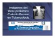 Imágenes del tórax pediátrico Cuándo Pensar en · PDF filePrimoinfección Progresión de la lesión pulmonar TBC Primaria En los niños pequeños se observa la forma primaria de