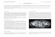 Tumor fibroso solitario hepático. Descripción de un caso y ...scielo.isciii.es/pdf/diges/v107n10/es_nota_clinica.pdfque principalmente se localice en la cavidad torácica o pleura