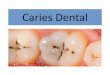 Caries Dentalecaths1.s3.amazonaws.com/anatomiapatologicaodontount/1436020438... · • Caries dental que se extiende a lo largo de la unión amelodentinaria y compromete al tejido