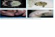 FOTOS 3 y 4. Sarna nodular con afectación de pies y …2011.elmedicointeractivo.com/formacion_acre2007/pdf/1045.pdf · Pthirius pubis. FOTO 10. Lesiones de pediculosis pubis. . Title: