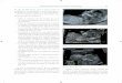 Cribado Materno-Fetal en el Embarazo de Alto Riesgo 31media.axon.es/pdf/86011_1.pdf · Translucencia nucal normal. Fig. 2-2. Nótese el amnios y la TN. ... Cuando la TN coincide con