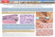 Histiocitosis de células de Langerhans en vulva · Histiocitosis de células de Langerhans en vulva Gómez Leal P, Martínez Martínez A, García Cegarra PM, Donzo Tobele M, Ortiz