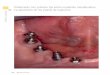 Tratamiento con prótesis fija sobre implantes … MAXILARIS JUNIO 2013.pdf · en esta última zona. En total, se incorporaron nueve implantes ... Prueba de dientes en la que se observa
