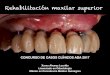 Rehabilitación maxilar superior - …auladentalavanzada.com/wp-content/uploads/2017/12/Xurxo-Alvarez... · CONCURSO DE CASOS CLÍNICOS ADA 2017 Rehabilitación maxilar superior Xurxo