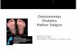 Osteotomias Distales Hallux Valgus - Cirugía del pie y ... · Roberto de los Mozos Unidad de Pie y Tobillo Cirugía Ortopédica y Traumatología. H.Universitario de Alava VIII CURSO