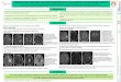 ENFERMEDADES DESMIELINIZANTES P1 Grau … · tratados con fibrinolisis por lo que la neuroimagen es esencial para establecer un correcto diagnóstico 'Las características radiológicas