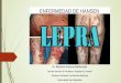 Enfermedad de Hansen (LEPRA) - entrepediatras.cl · Historia La palabra lepra, viene del griego antiguo . Lepra = escama. Del verbo . Lepein= pelar ... Esta resistencia natural proviene