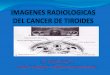 Dr. Jorge Ferrey M Medico radiólogo –radiólogo ... · Quiste tirogloso Quiste branquial, de retención 