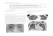 CASO CLÍNICO ARP Nº 6: PNEUMONIA POR PNEUMOCYSTIS ... 107 ccARPn6.pdf · a pneumonia bilateral, praticamente todos por Pneumocystis jirovecii (apenas um caso por infeção por citomegalovirus)2