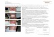 Resolución de una herida postraumática localizada … 20-06-07 se inicia tratamiento con IRUXOL®MONO (colagenasa) para eliminar los restos de tejido no viable del lecho de la herida