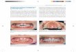 Aparato Removible en Tratamiento de un Diastema Causado ...media.axon.es/pdf/88942_3.pdf · Manejo de los Diastemas en Incisivos 143 Aparato Removible en Tratamiento de un Diastema
