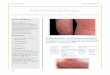 Eritrodermia y acné - medicina-ucr.commedicina-ucr.com/quinto/wp-content/uploads/2015/02/12.-Eritrodermia-y... · disminuido en los pacientes con acné y tiene un rol importante
