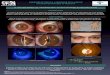  · palpebral, atrofia de glándula lagrimal, alteraciones en los reflejos pupilares, hipersensibilidad a mióticos diluidos, ambliopía y atrofia óptica. CASO CLíNlCO Varón de