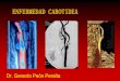 Presentación de PowerPoint - Dr. Gerardo Peon · -estenosis recurrente-bifurcacion carotidea alta , lesiones extensas-antecedentes de cirugia radical y/o radiacion february 2001