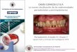 CASOS CLÍNICOS E.T.E.P. La nueva clasificación de las ...€¦ · periodontal and peri-implant diseases and conditions - Introduction and key changes from the 1999 classification